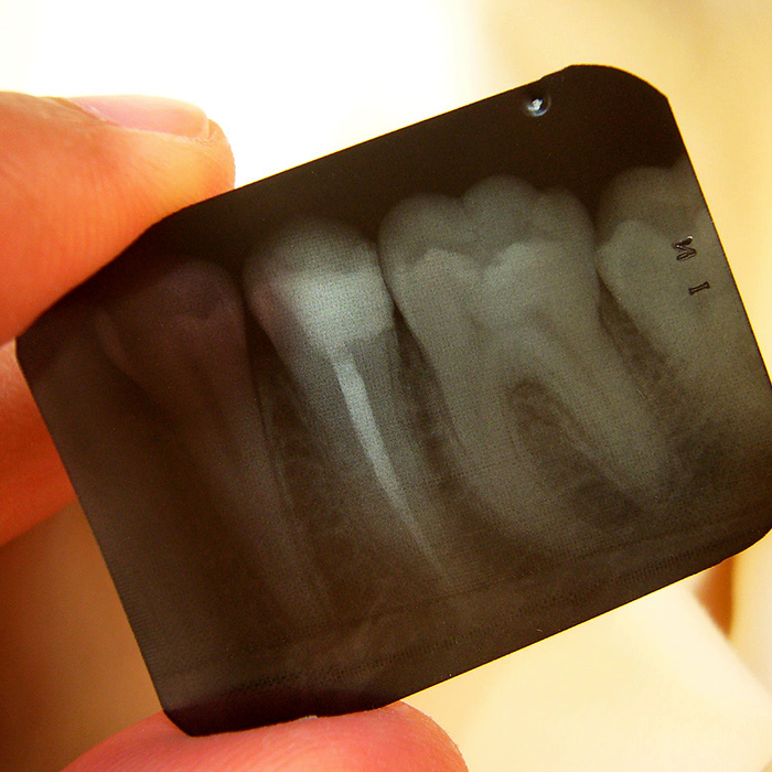 Xray of teeth