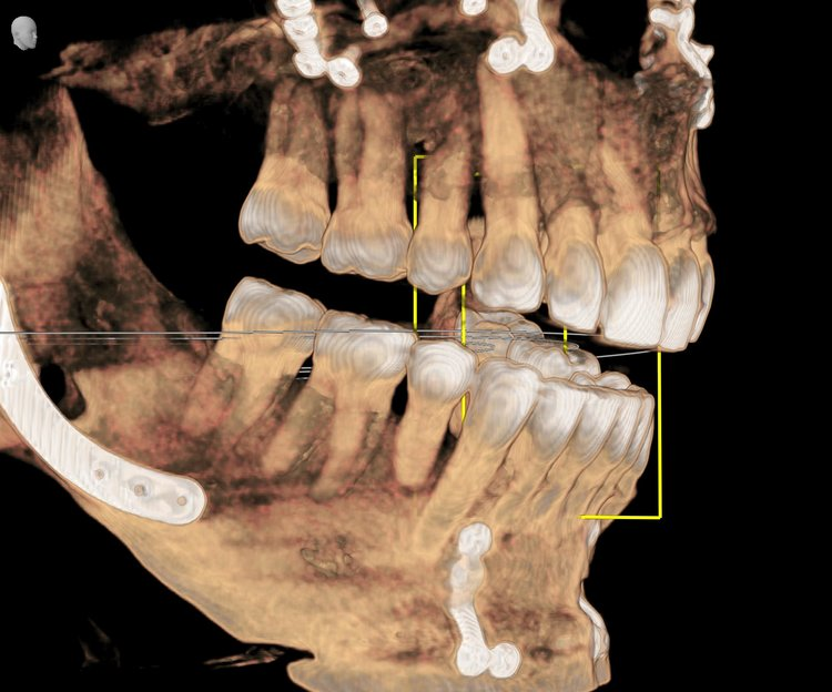 A scan from CBCT