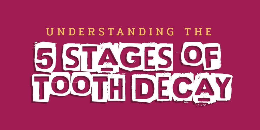 Understanding the 5 stages of tooth decay headline