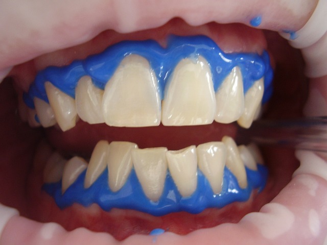 A mouth ready for laser teeth whitening service.