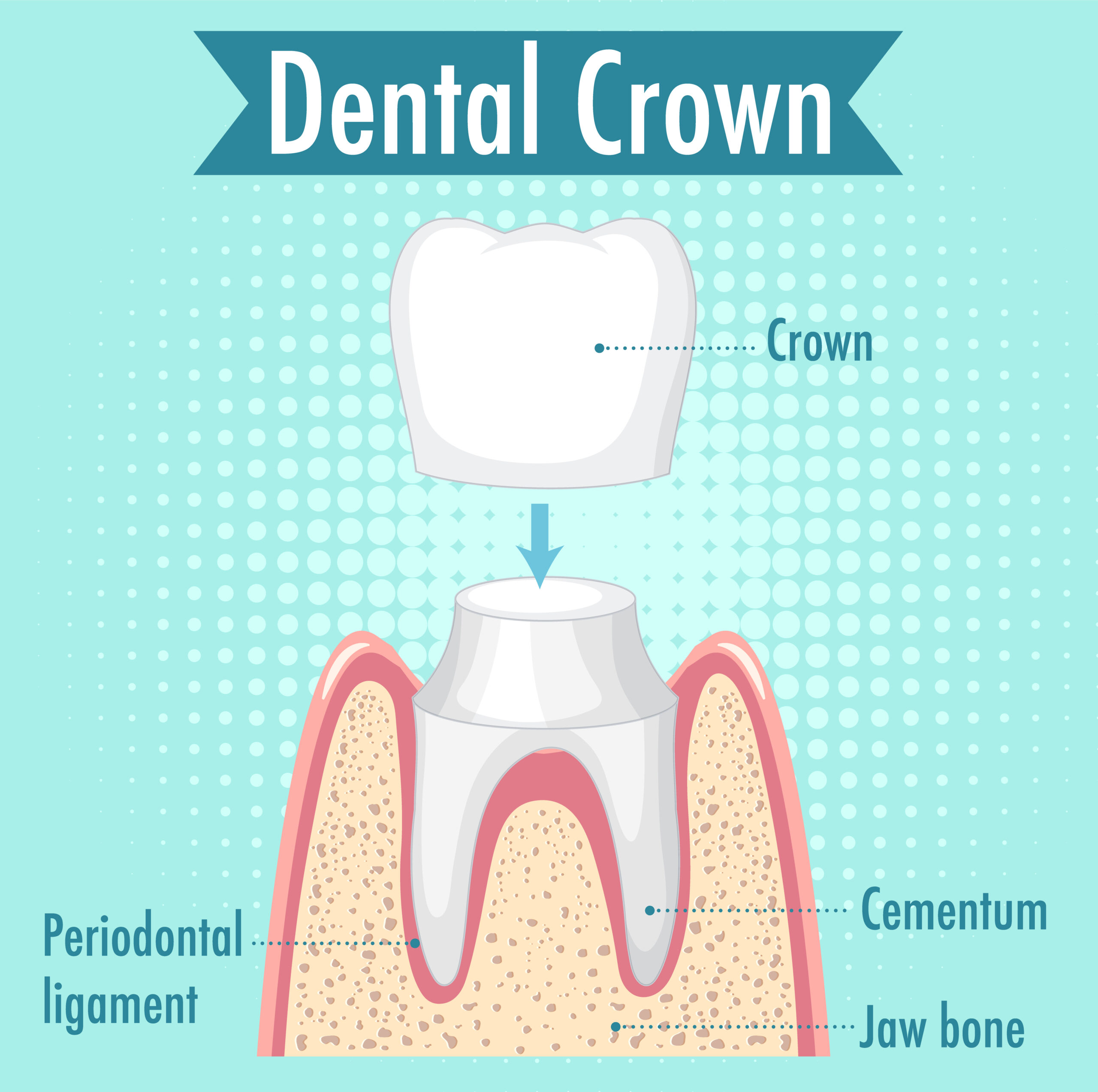 Types of Dental Crowns Blog Graphic