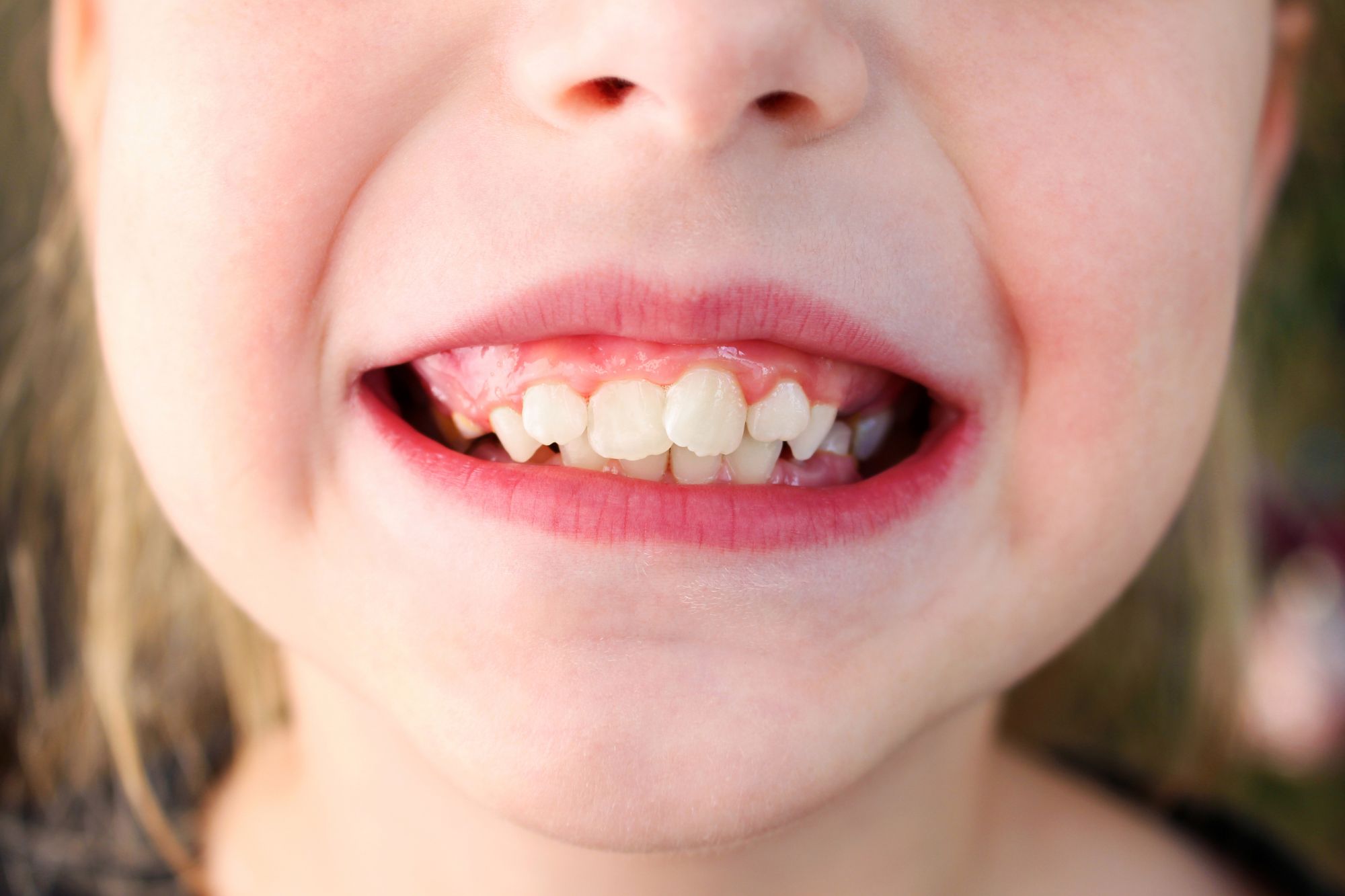 Understanding crowded teeth blog graphic