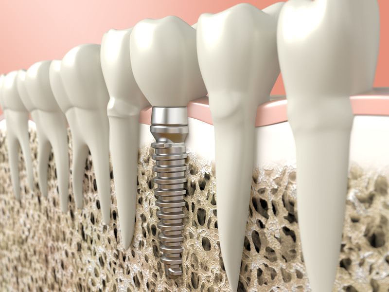 Reclaim Your Favorite Foods with Dental Implants