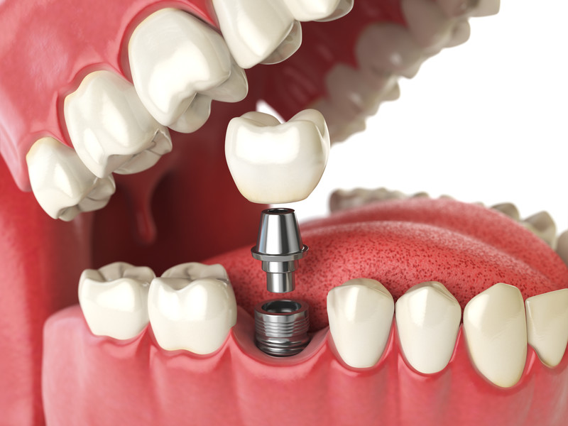 Exploring Dental Implant Options for a Confident Smile