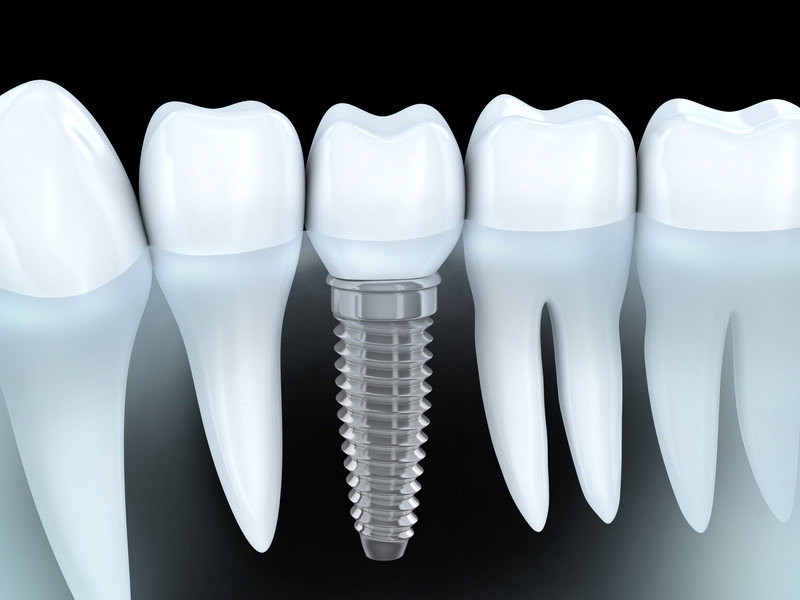 Dental Implants: Cavity-Proof Teeth Replacement Option
