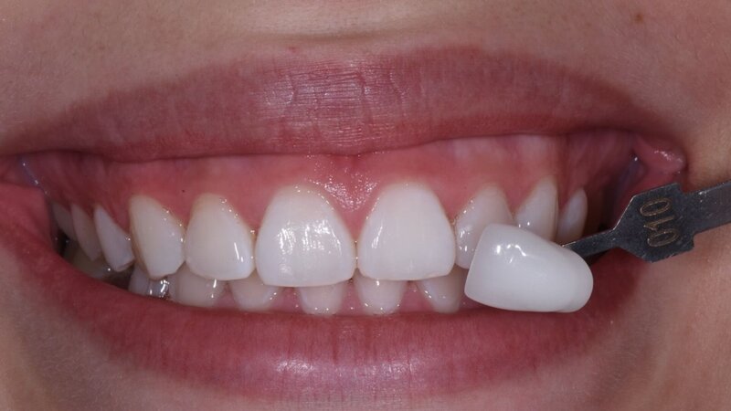 Patient's bright white teeth after professional teeth whitening treatment at Randall K. McVey, DMD PA in Garden City, KS