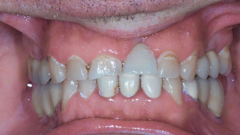 Close-up of patient's teeth after dental implant placement at Randall K. McVey, DMD PA in Garden City, KS