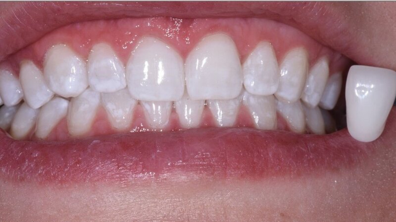 After Teeth Whitening Treatment Garden City