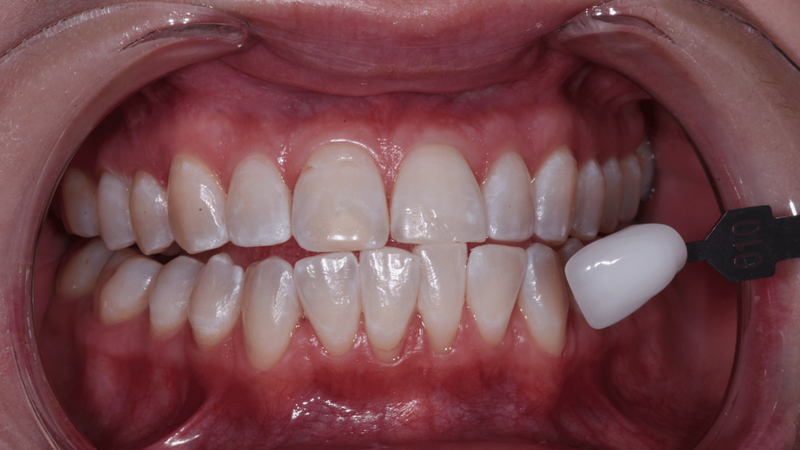 Patient's bright white teeth after professional teeth whitening treatment at Randall K. McVey, DMD PA in Garden City, KS