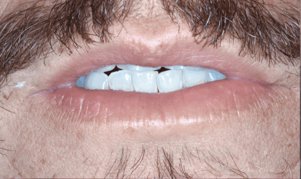 Patient's beautiful smile after porcelain veneers treatment at Randall K. McVey, DMD PA in Garden City, KS