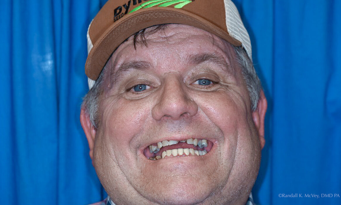Patient's smile before dental implant treatment at Randall K. McVey, DMD PA in Garden City, KS
