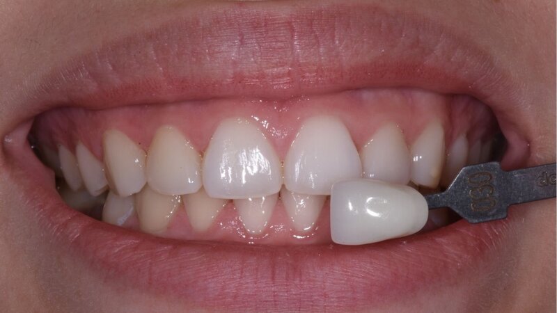 Patient's teeth before professional teeth whitening treatment at Randall K. McVey, DMD PA in Garden City, KS