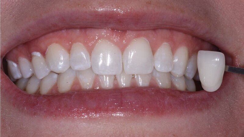 Patient's teeth before professional teeth whitening treatment at Randall K. McVey, DMD PA in Garden City, KS