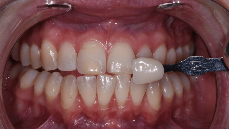 Patient's teeth before professional teeth whitening treatment at Randall K. McVey, DMD PA in Garden City, KS