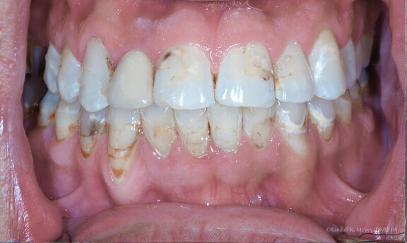 Patient's teeth before porcelain veneers treatment at Randall K. McVey, DMD PA in Garden City, KS