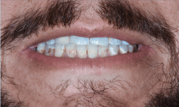 Patient's teeth before porcelain veneers treatment at Randall K. McVey, DMD PA in Garden City, KS