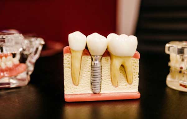 Cross-section model showing dental implant placed in jawbone at Randall K. McVey, DMD PA in Garden City, KS