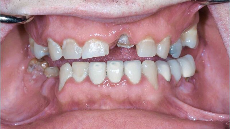 Close-up of patient's teeth before dental implant placement at Randall K. McVey, DMD PA in Garden City, KS