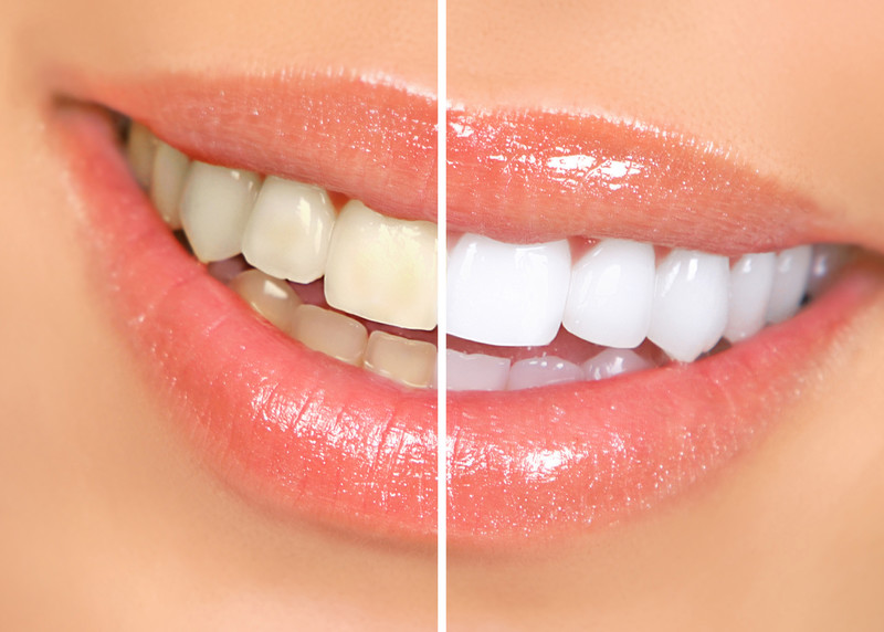 Teeth Whitening Before and After Garden City KS Before and after results of professional teeth whitening treatment at Randall K. McVey, DMD PA in Garden City, KSRetry
