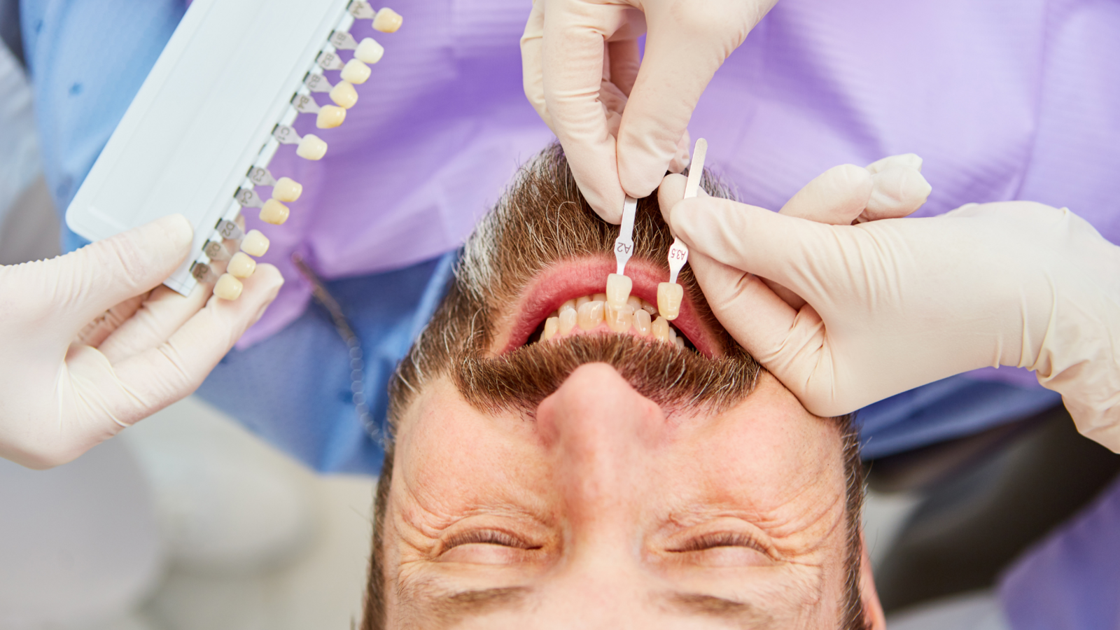 Man getting teeth color matched for veneers at Randall K. McVey, DMD PA in Garden City, KS